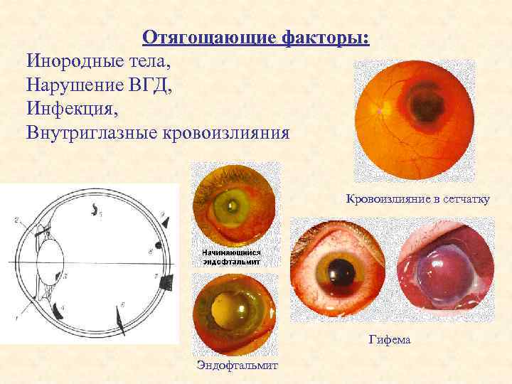 Отягощающие факторы: Инородные тела, Нарушение ВГД, Инфекция, Внутриглазные кровоизлияния Кровоизлияние в сетчатку Гифема Эндофтальмит