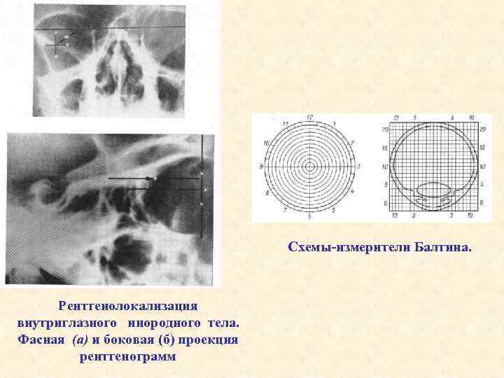 Схемы-измерители Балтина. Рентгенолокализация внутриглазного инородного тела. Фасная (а) и боковая (б) проекция рентгенограмм 