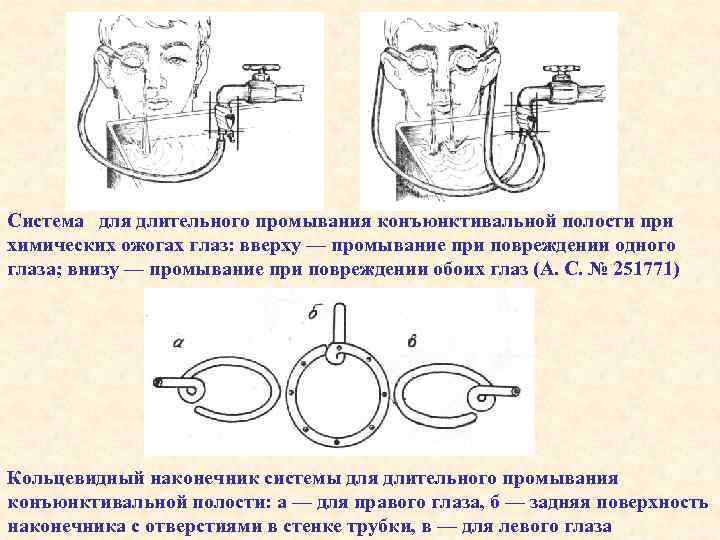 Система для длительного промывания конъюнктивальной полости при химических ожогах глаз: вверху — промывание при