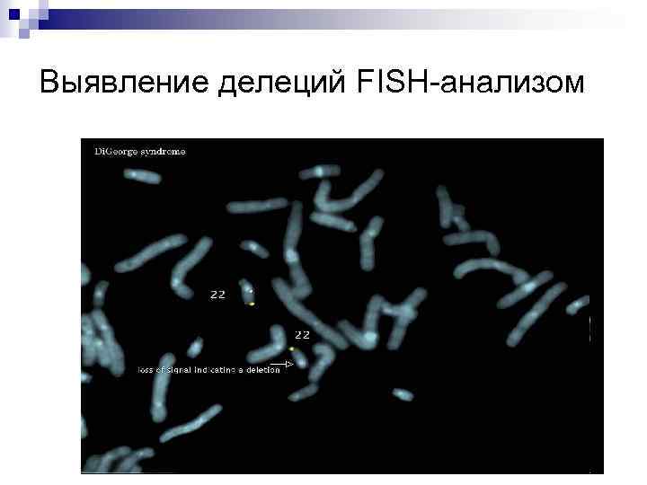 Выявление делеций FISH-анализом 