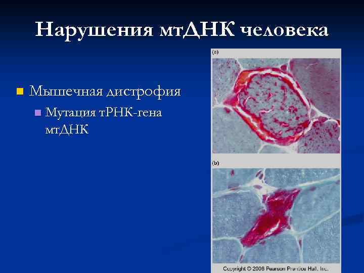 Нарушения мт. ДНК человека n Мышечная дистрофия n Мутация т. РНК-гена мт. ДНК 