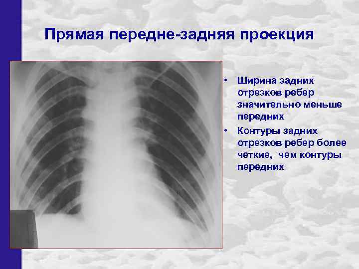 Прямая передне-задняя проекция • Ширина задних отрезков ребер значительно меньше передних • Контуры задних