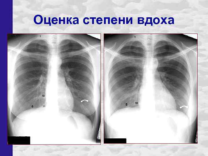 Оценка степени вдоха 6 5 