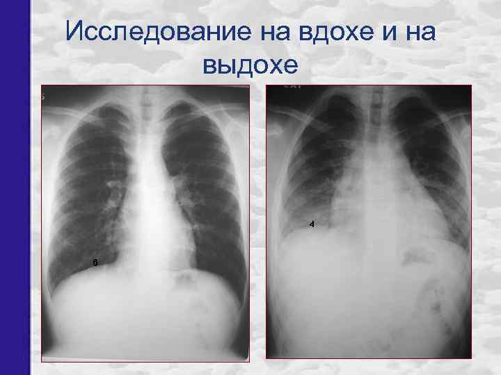 Исследование на вдохе и на выдохе 4 6 