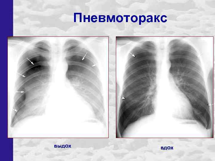 Пневмоторакс выдох вдох 