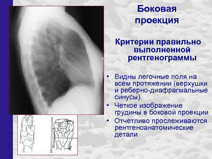 Боковая проекция Критерии правильно выполненной рентгенограммы • Видны легочные поля на всем протяжении (верхушки