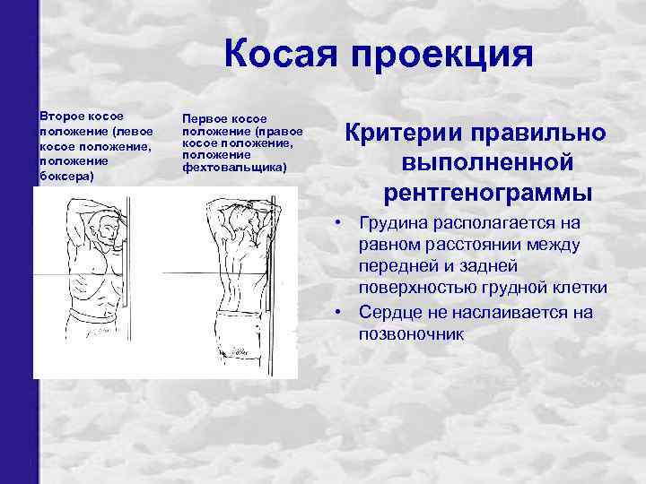 Косая проекция Второе косое положение (левое косое положение, положение боксера) Первое косое положение (правое