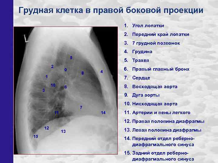 Грудная клетка в правой боковой проекции 1. Угол лопатки 2. Передний край лопатки 3.