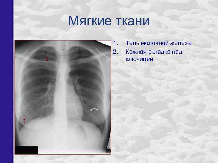 Мягкие ткани 1. 2. 2 1 Тень молочной железы Кожная складка над ключицей 