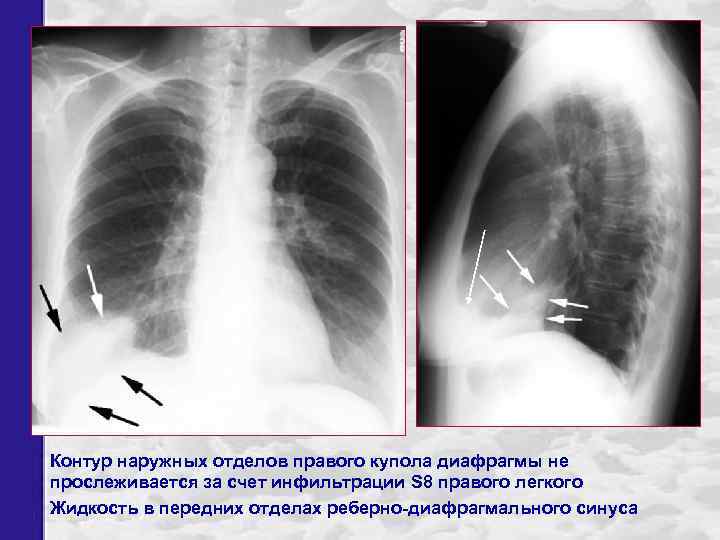 Контур наружных отделов правого купола диафрагмы не прослеживается за счет инфильтрации S 8 правого