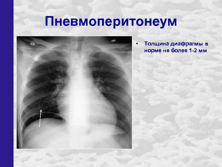 Пневмоперитонеум • Толщина диафрагмы в норме не более 1 -2 мм 