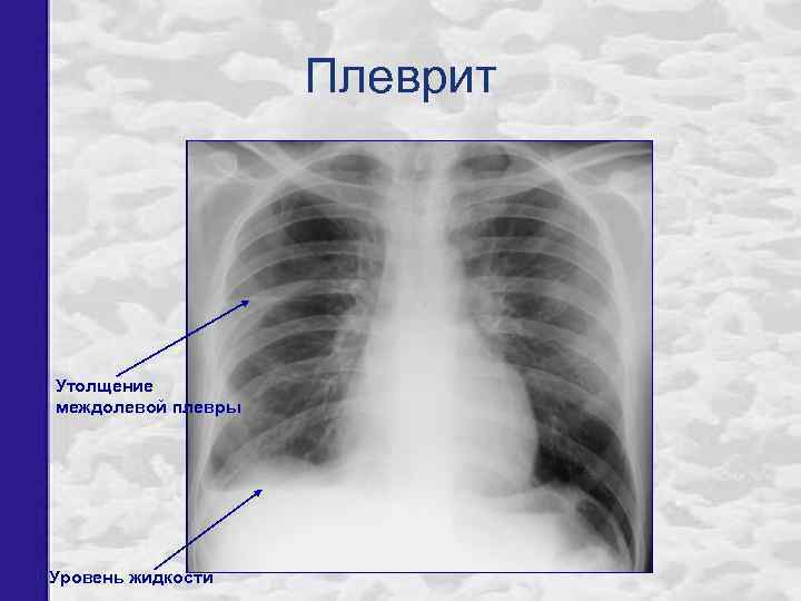 Плеврит Утолщение междолевой плевры Уровень жидкости 