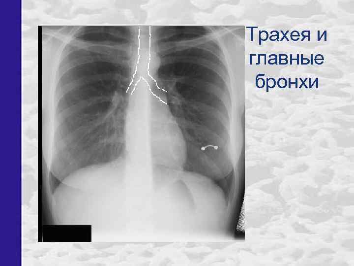 Трахея и главные бронхи 
