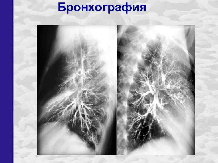 Бронхография 