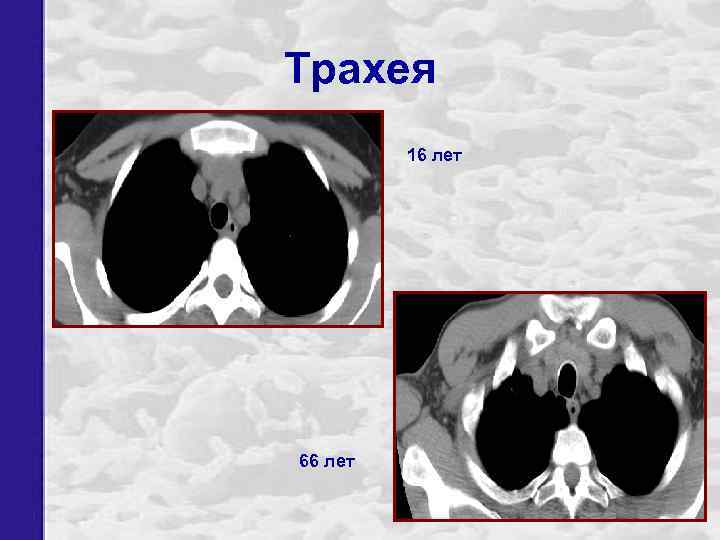 Трахея 16 лет 66 лет 