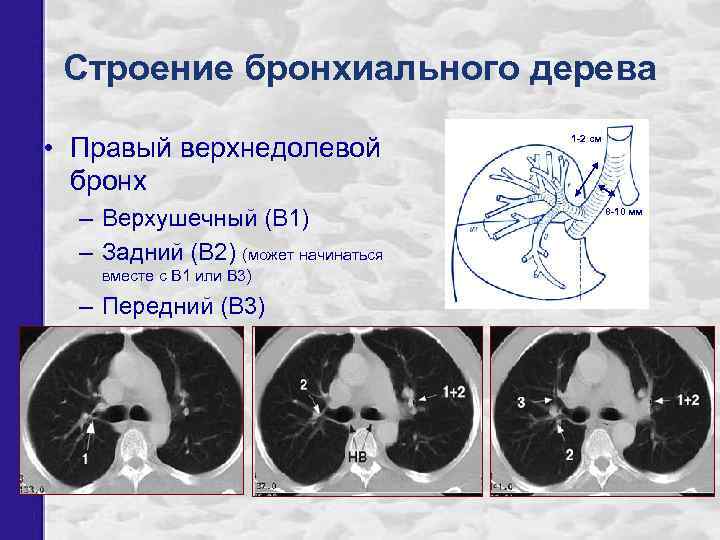 Строение бронхиального дерева • Правый верхнедолевой бронх – Верхушечный (В 1) – Задний (В