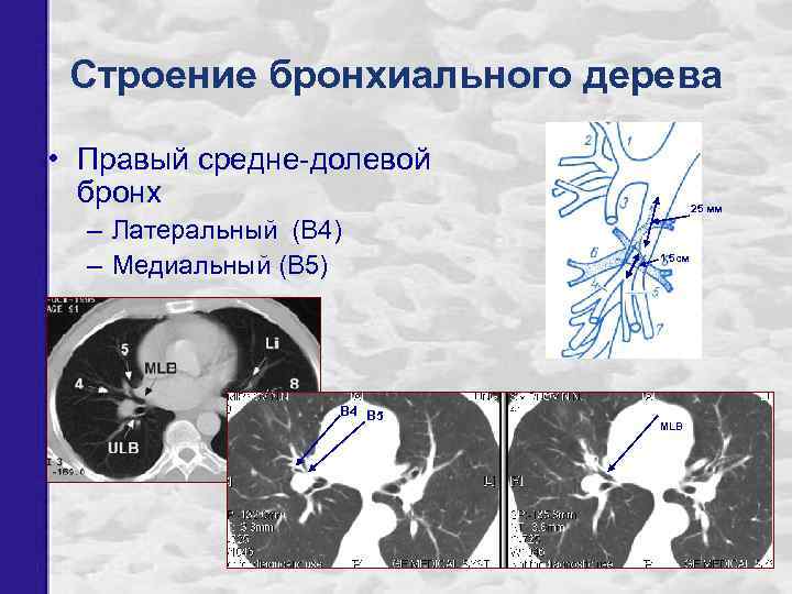 Строение бронхиального дерева • Правый средне-долевой бронх – Латеральный (В 4) – Медиальный (В