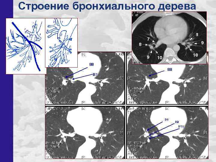 Строение бронхиального дерева В 8 В 7 В 8 В 9 В 10 