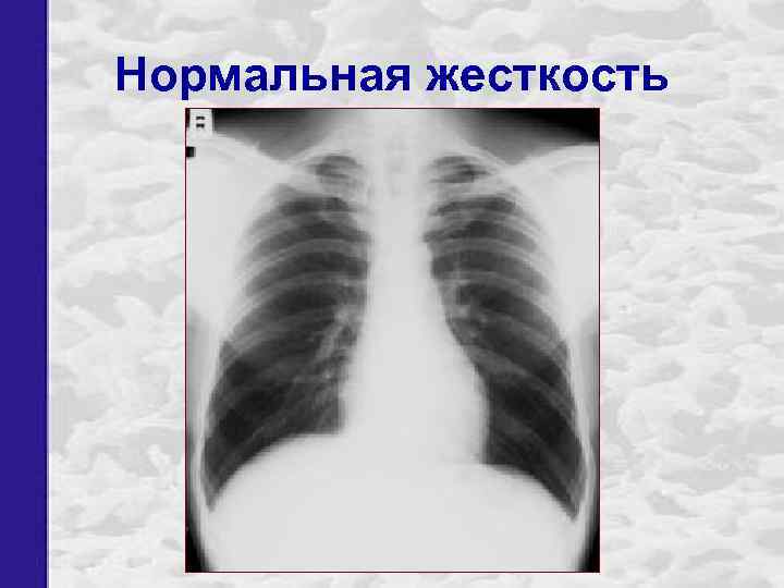 Нормальная жесткость 