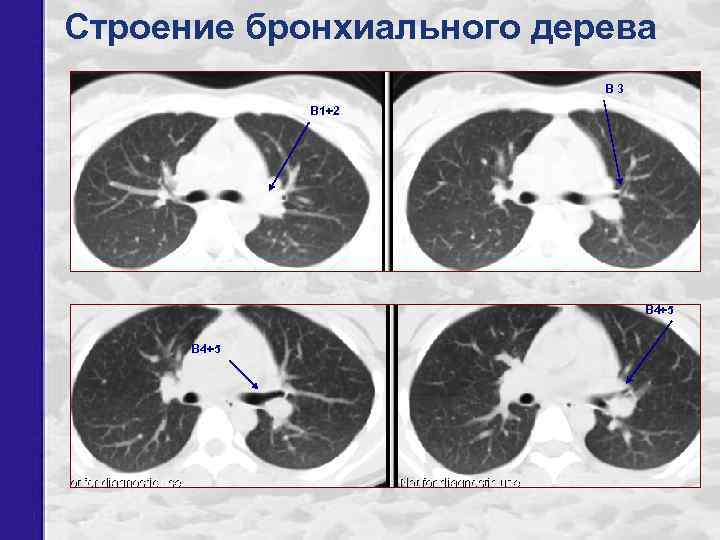 Строение бронхиального дерева В 3 В 1+2 В 4+5 