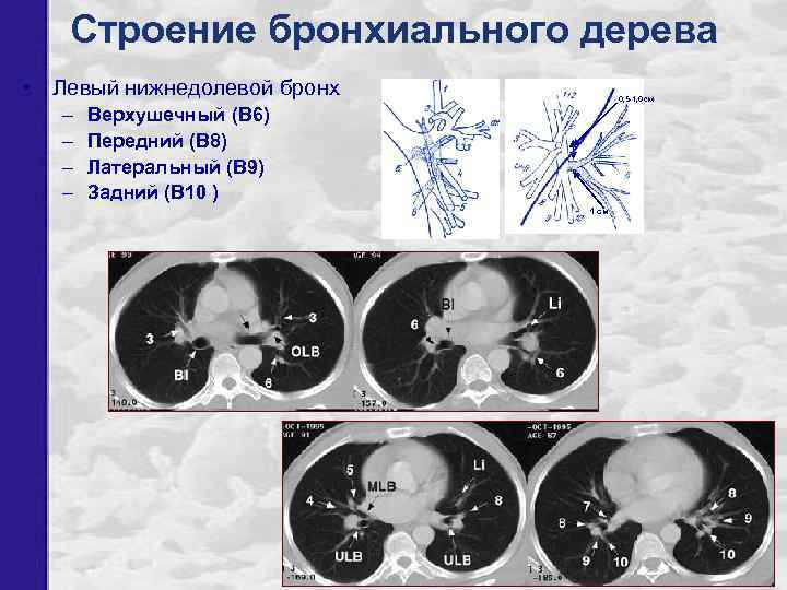 Строение бронхиального дерева • Левый нижнедолевой бронх – – 0, 5 -1, 0 см