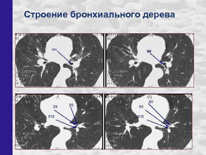 Строение бронхиального дерева UBL В 9 В 10 В 6 В 8 В 9