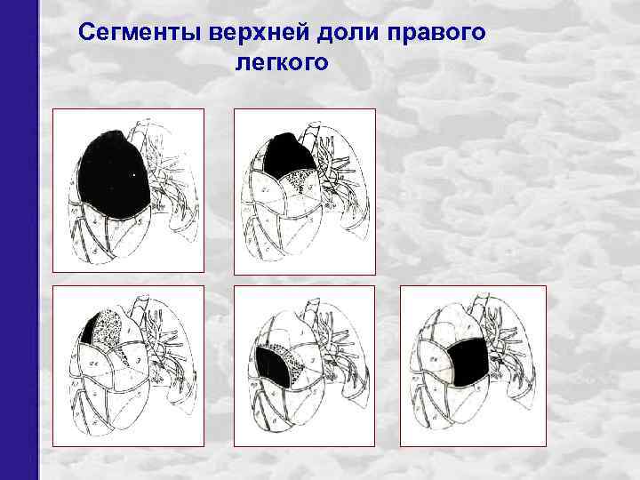 Сегменты верхней доли правого легкого 