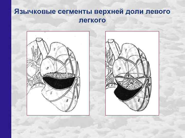 Усиление и деформация легочного рисунка