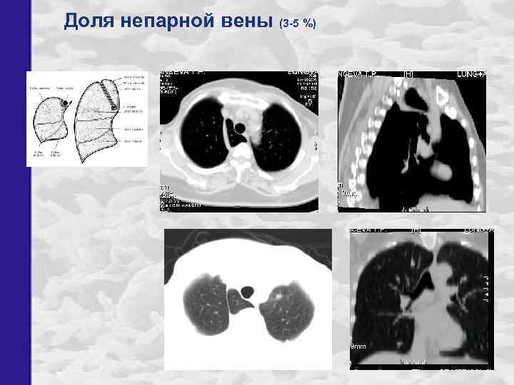 Доля непарной вены (3 -5 %) 