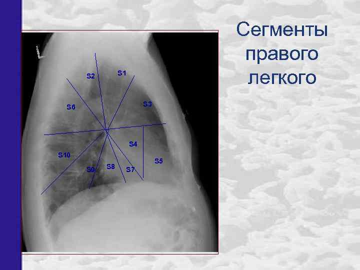 Сегменты правого легкого S 1 S 2 S 3 S 6 S 4 S