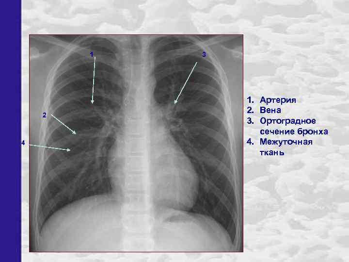 1 2 4 3 1. Артерия 2. Вена 3. Ортоградное сечение бронха 4. Межуточная