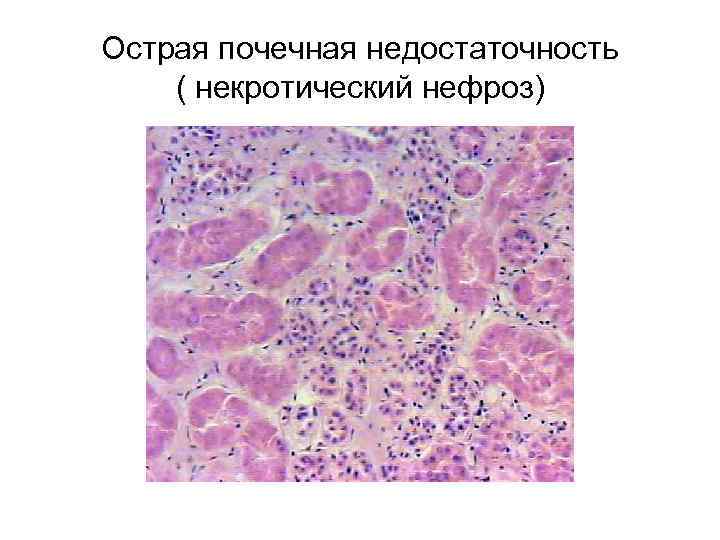 Острая почечная недостаточность ( некротический нефроз) 