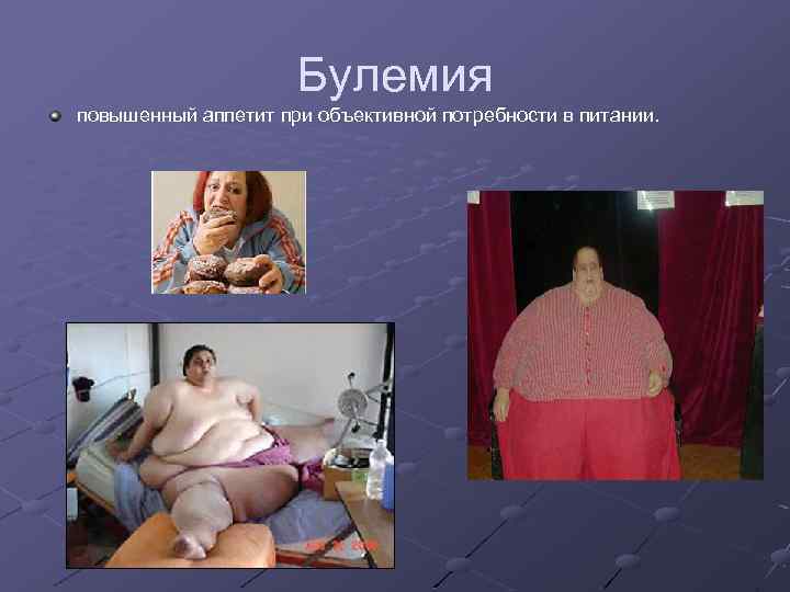 Булемия повышенный аппетит при объективной потребности в питании. 