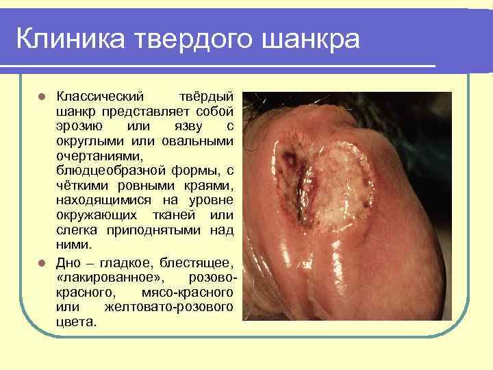 Клиника твердого шанкра Классический твёрдый шанкр представляет собой эрозию или язву с округлыми или