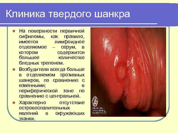 Клиника твердого шанкра На поверхности первичной сифиломы, как правило, имеется лимфоидное отделяемое – серум,