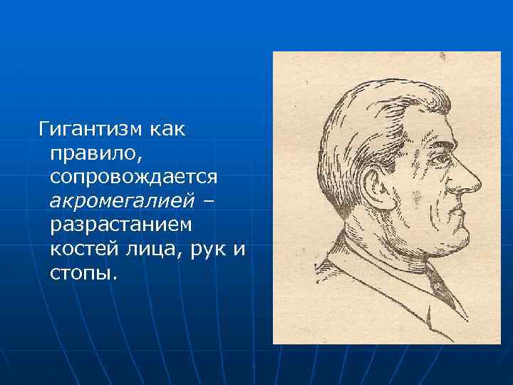 Гигантизм как правило, сопровождается акромегалией – разрастанием костей лица, рук и стопы. 