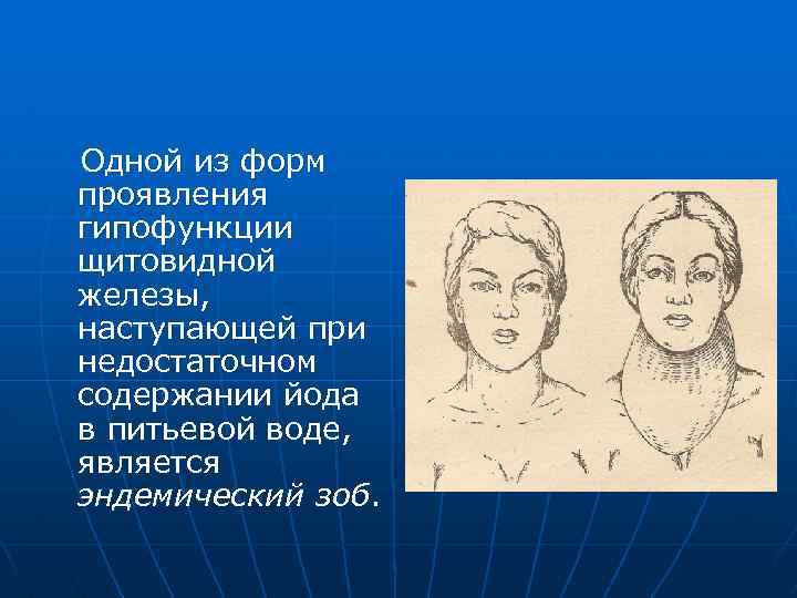 Одной из форм проявления гипофункции щитовидной железы, наступающей при недостаточном содержании йода в питьевой