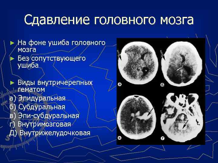 Сдавление головного мозга На фоне ушиба головного мозга ► Без сопутствующего ушиба ► Виды