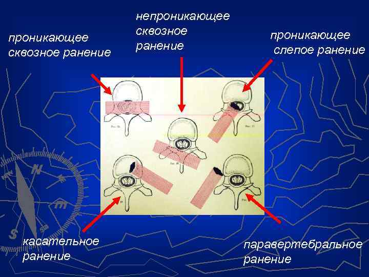 проникающее сквозное ранение касательное ранение непроникающее сквозное ранение проникающее слепое ранение паравертебральное ранение 