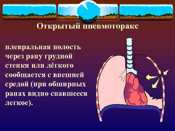 Открытый пневмоторакс плевральная полость через рану грудной стенки или лёгкого сообщается с внешней средой