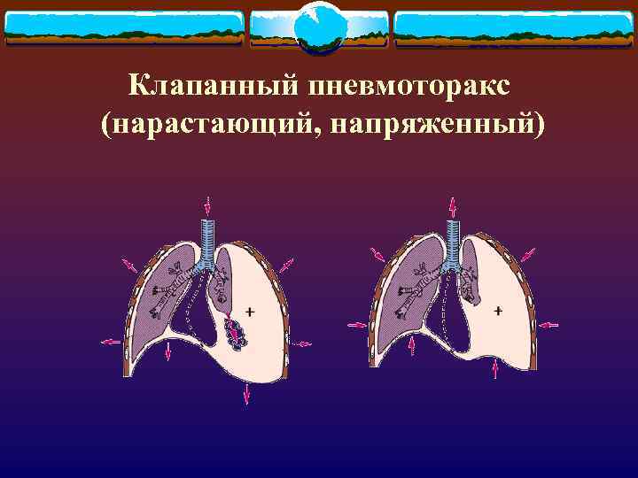 Клапанный пневмоторакс (нарастающий, напряженный) 