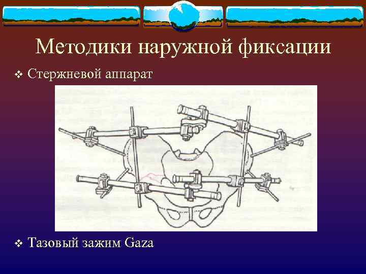 Методики наружной фиксации v Стержневой аппарат v Тазовый зажим Gaza 