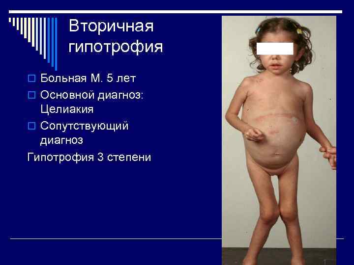 Вторичная гипотрофия o Больная М. 5 лет o Основной диагноз: Целиакия o Сопутствующий диагноз