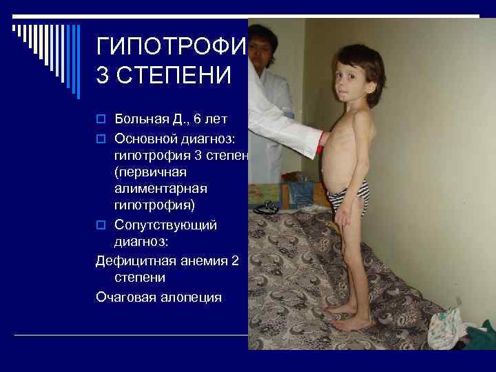 ГИПОТРОФИЯ 3 СТЕПЕНИ o Больная Д. , 6 лет o Основной диагноз: гипотрофия 3