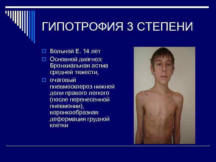 ГИПОТРОФИЯ 3 СТЕПЕНИ o Больной Е. 14 лет o Основной диагноз: Бронхиальная астма средней