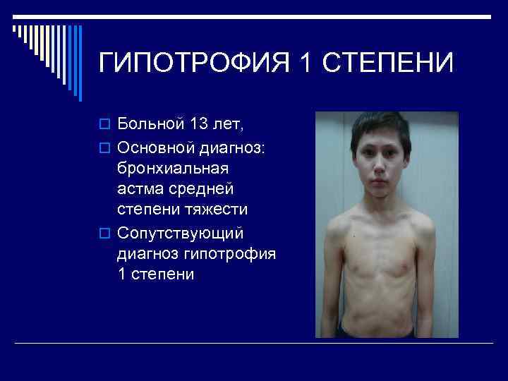 ГИПОТРОФИЯ 1 СТЕПЕНИ o Больной 13 лет, o Основной диагноз: бронхиальная астма средней степени