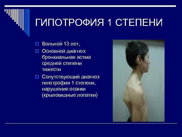 ГИПОТРОФИЯ 1 СТЕПЕНИ o Больной 13 лет, o Основной диагноз: бронхиальная астма средней степени
