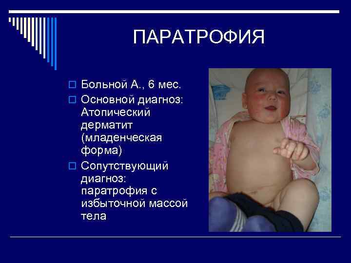 ПАРАТРОФИЯ o Больной А. , 6 мес. o Основной диагноз: Атопический дерматит (младенческая форма)