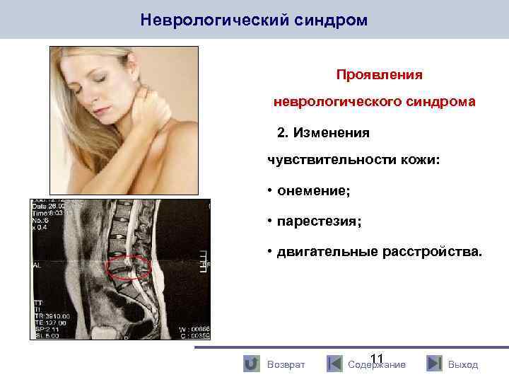 Неврологический синдром Проявления неврологического синдрома 2. Изменения чувствительности кожи: • онемение; • парестезия; •