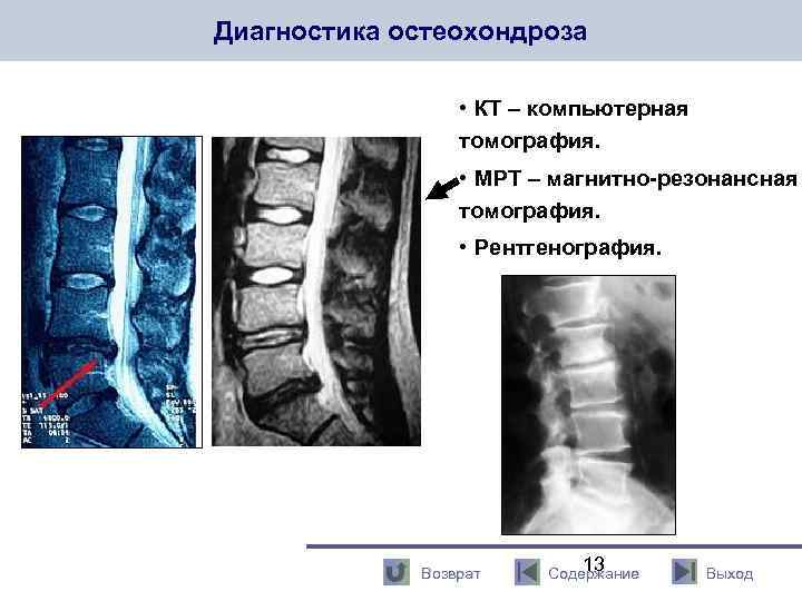 Диагностика остеохондроза • КТ – компьютерная томография. • МРТ – магнитно-резонансная томография. • Рентгенография.